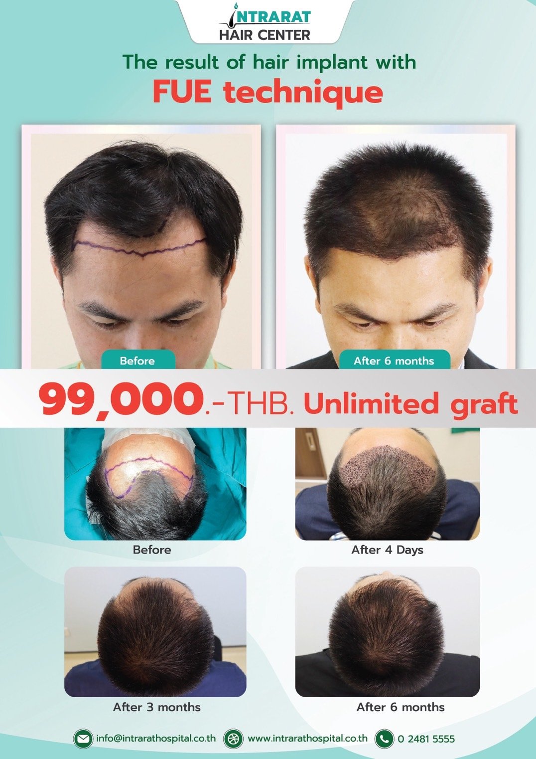 Hair Implant — Intrarat Hospital